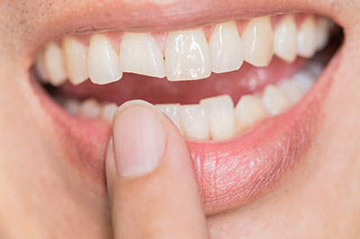 Dental Injury in Indianapolis